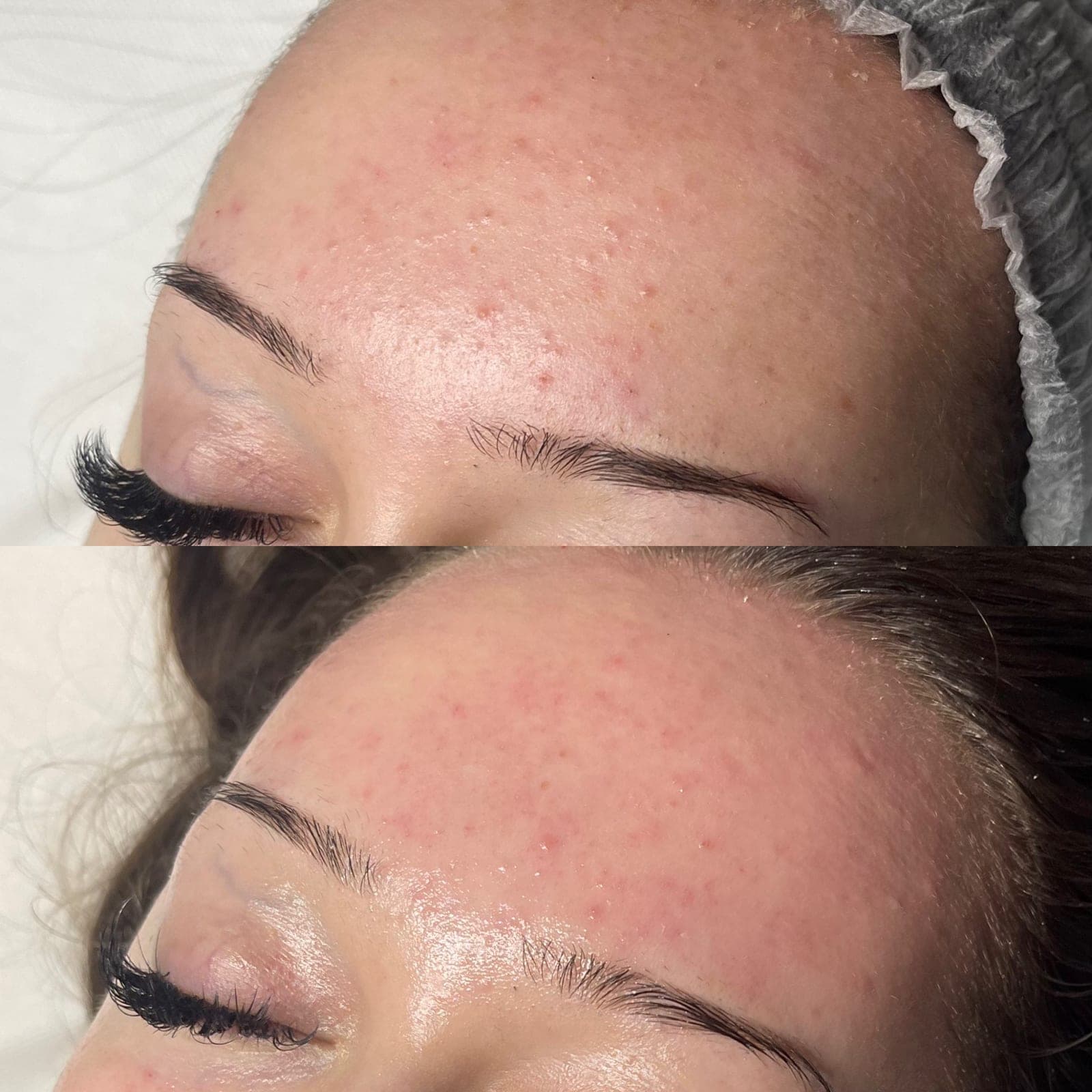 Microneedling 2