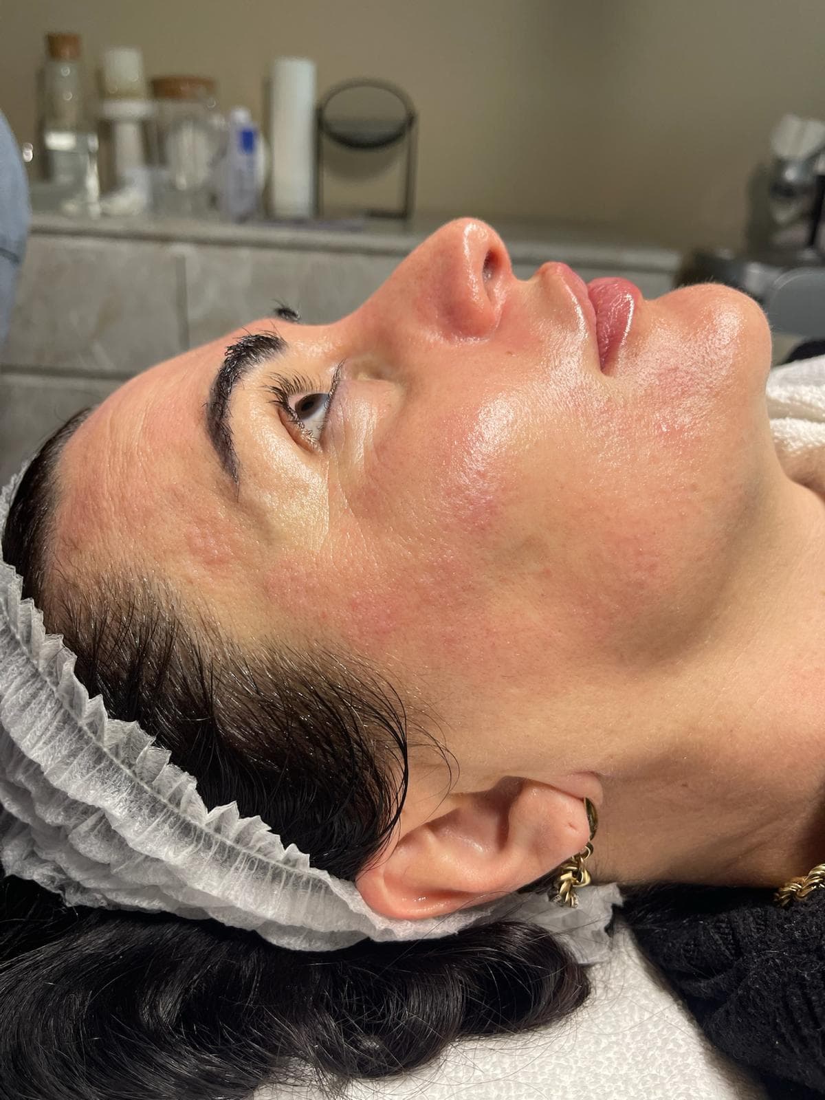 Microneedling 7
