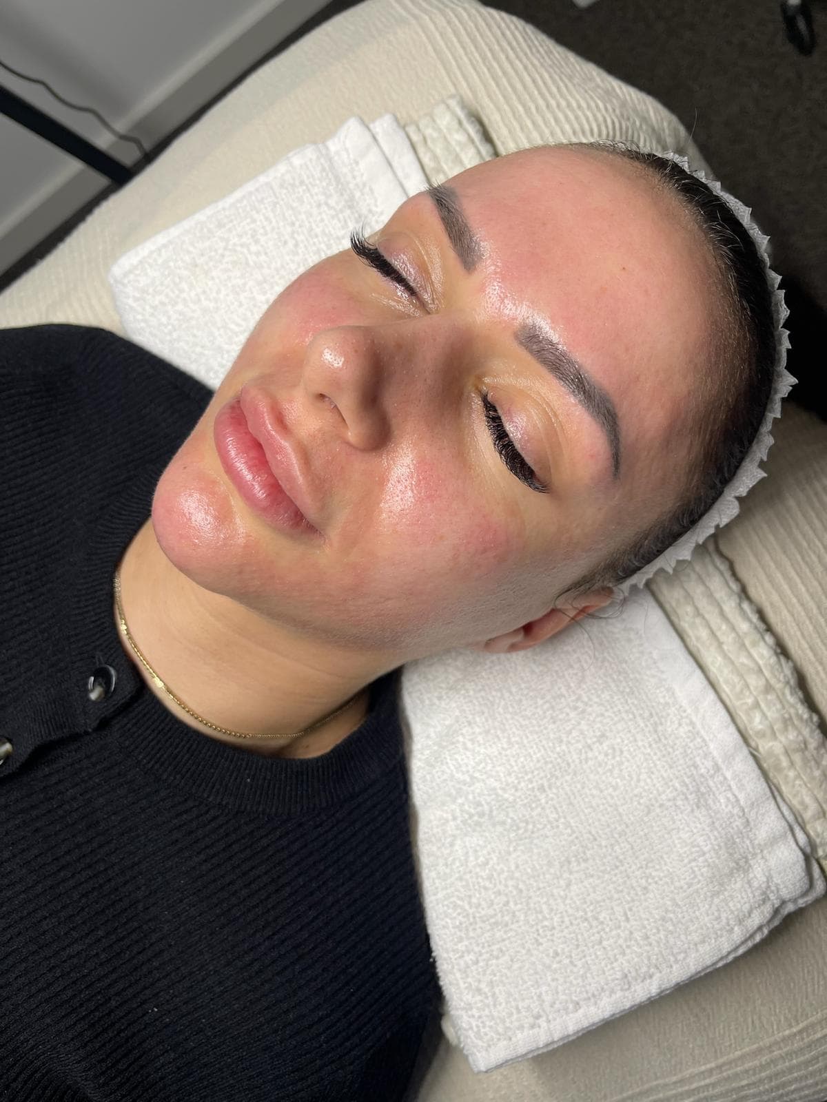 Microneedling 8