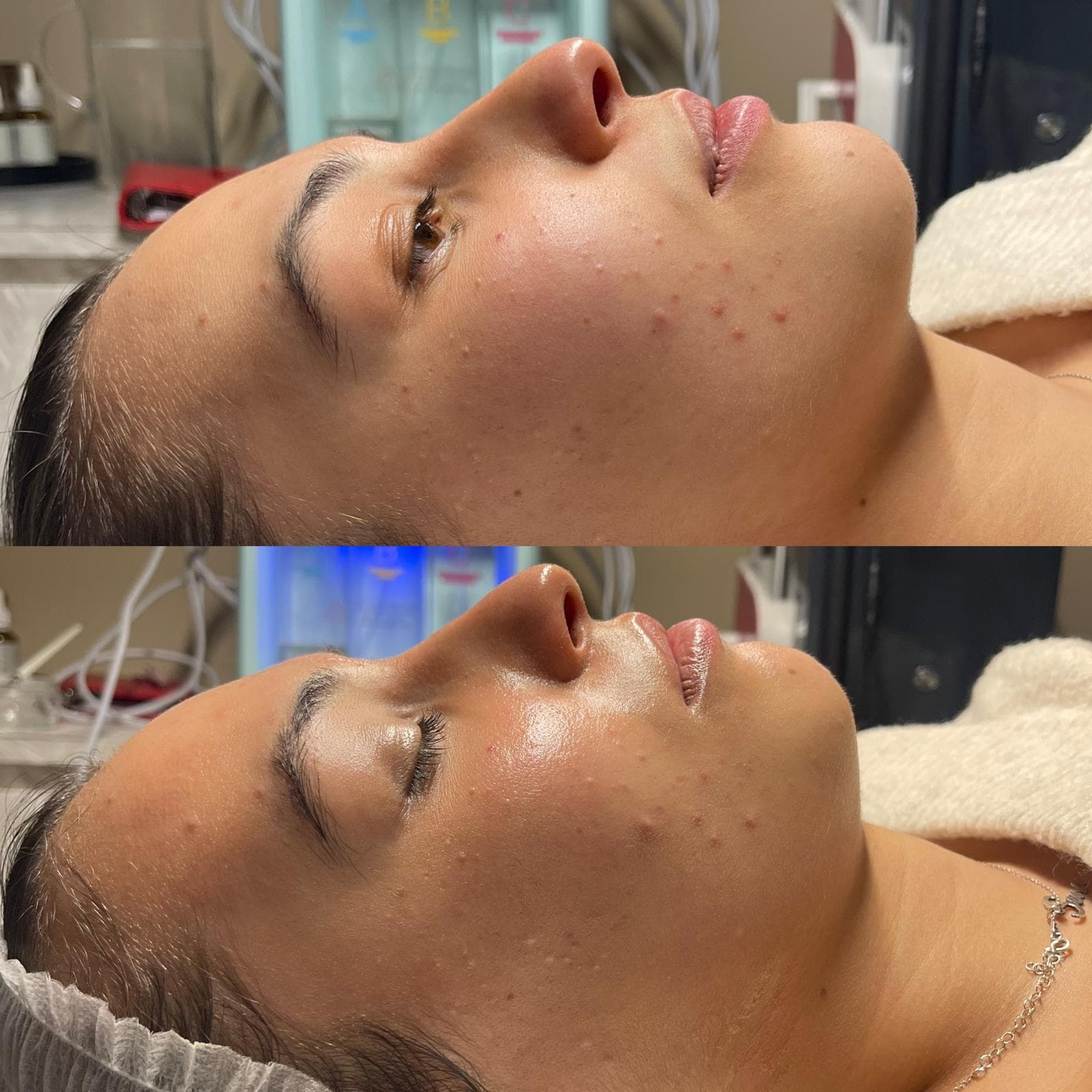 Microneedling 10