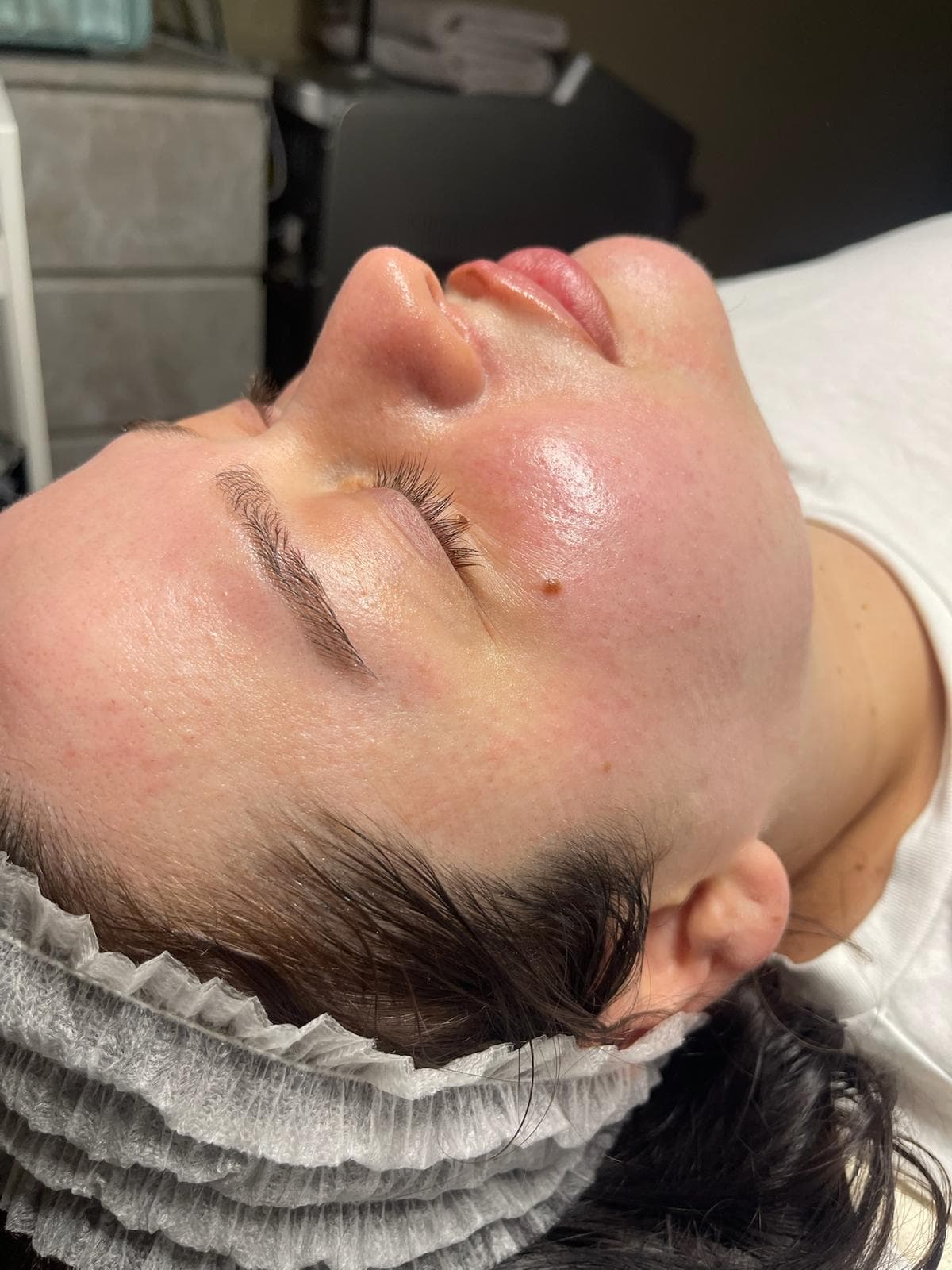 Microneedling 4