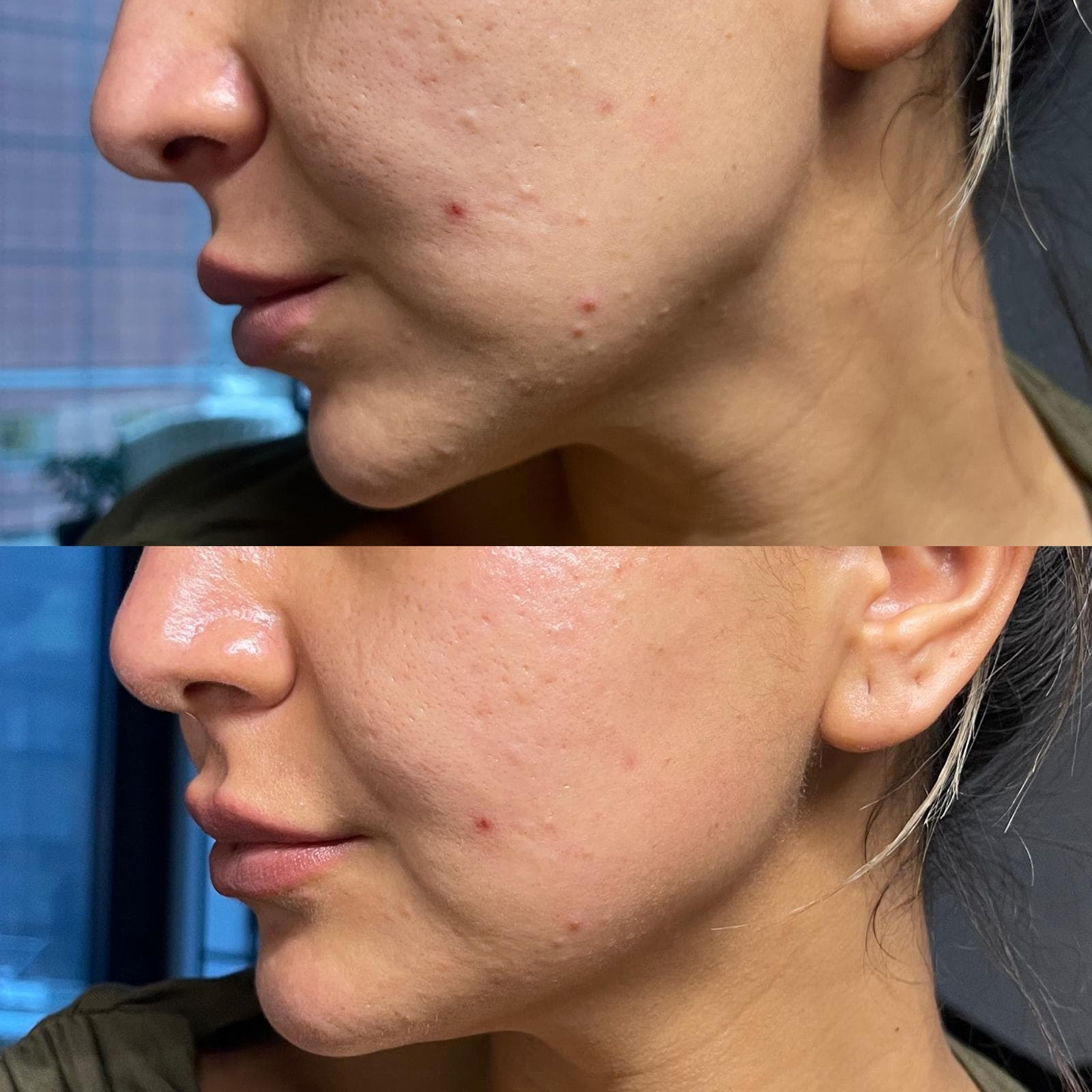 Microneedling 5