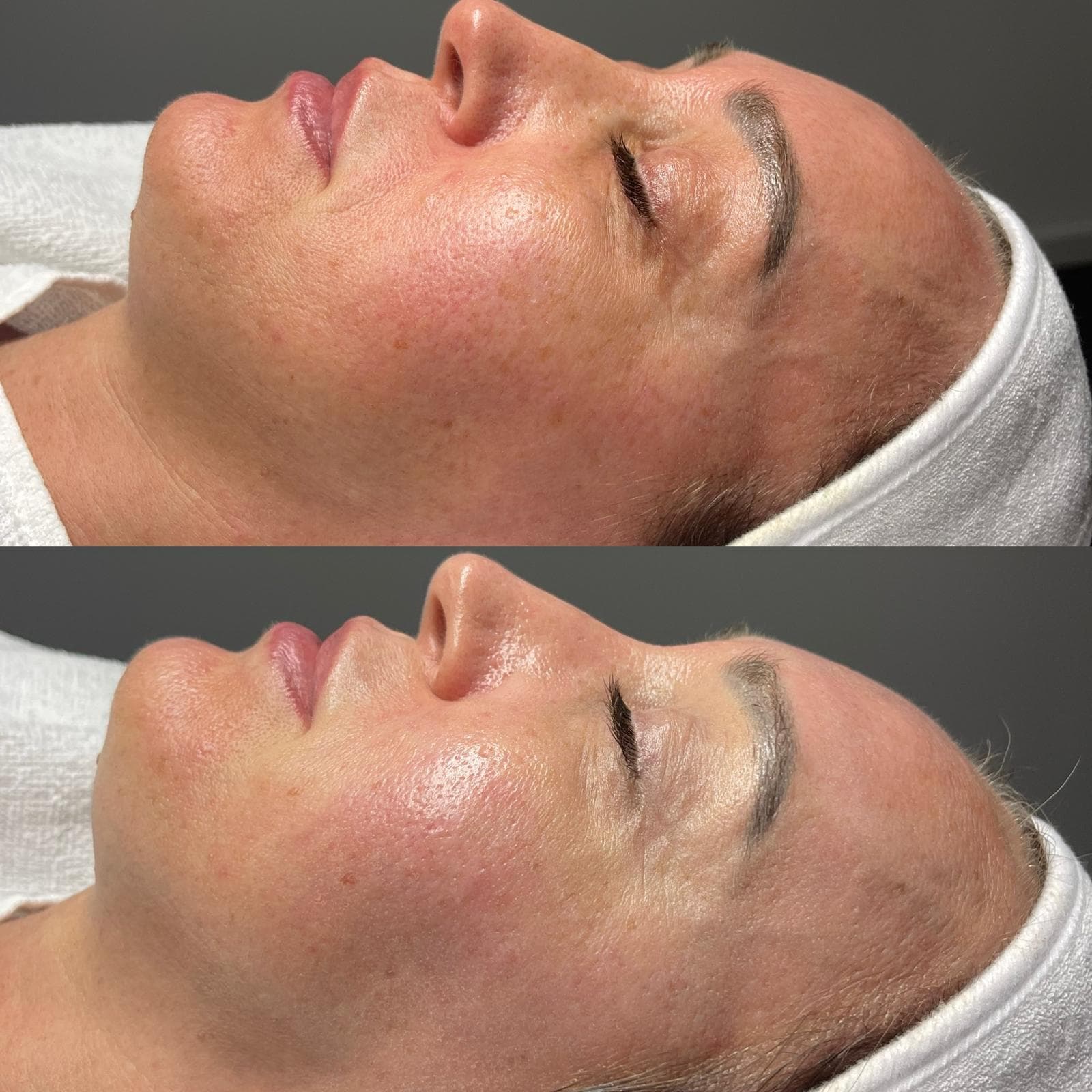 Microneedling 6
