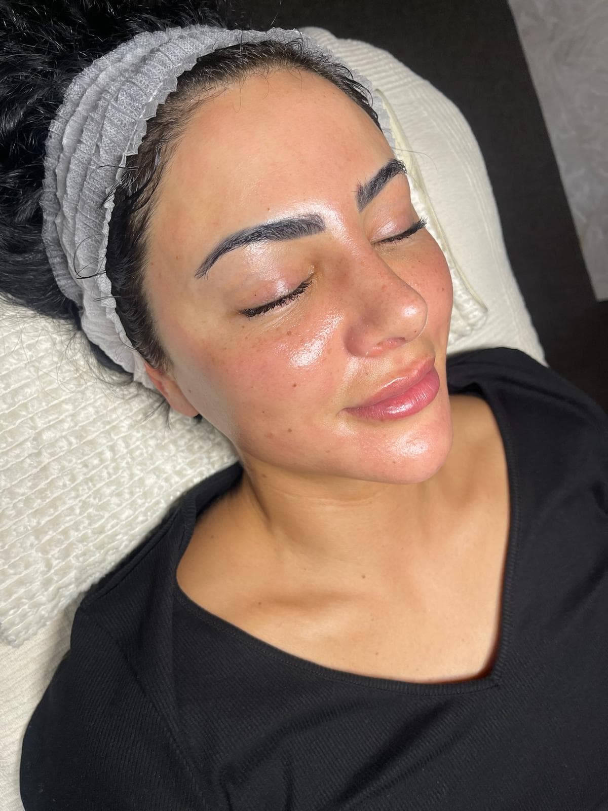 RF Microneedling 5