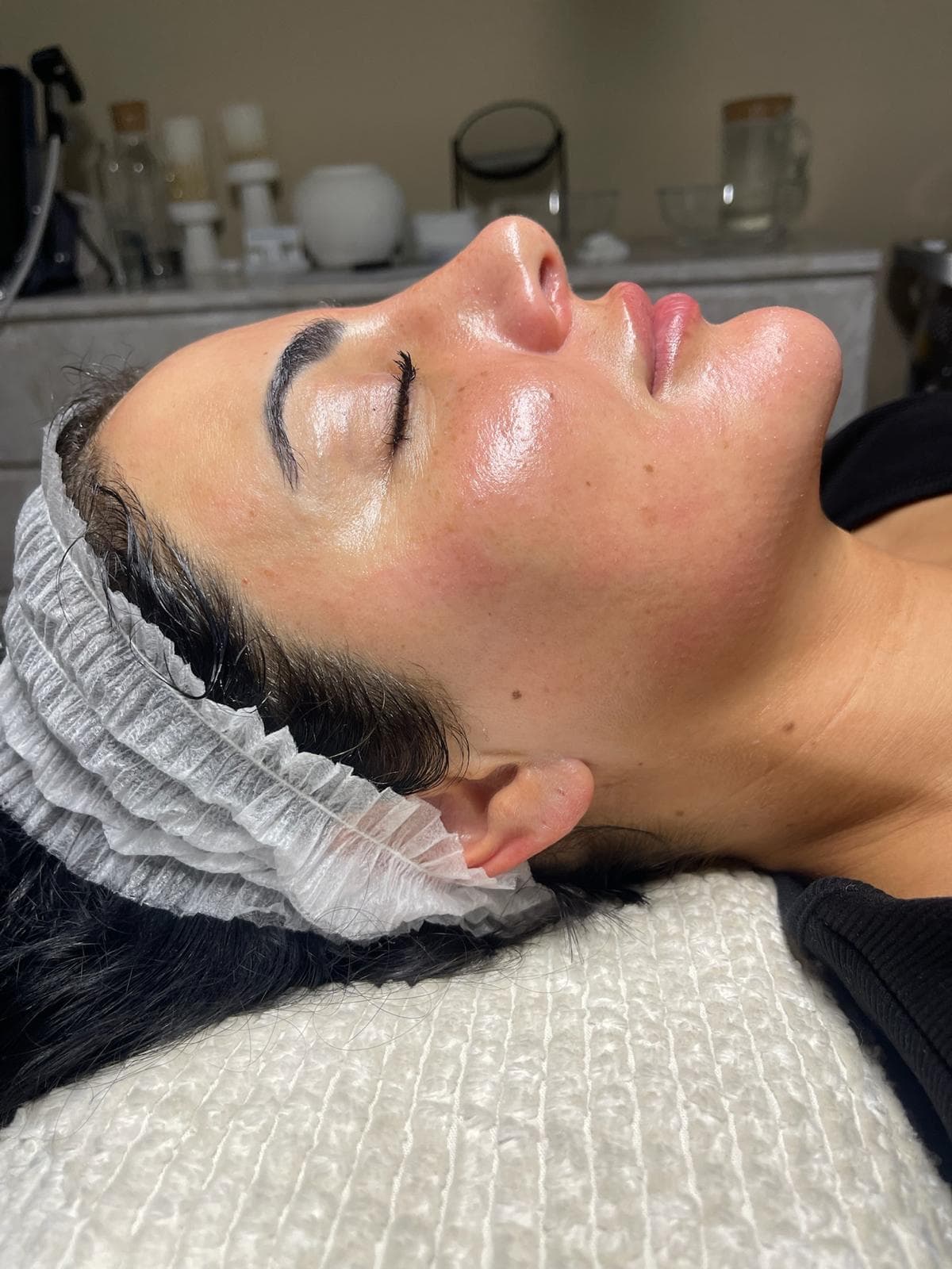 RF Microneedling 6