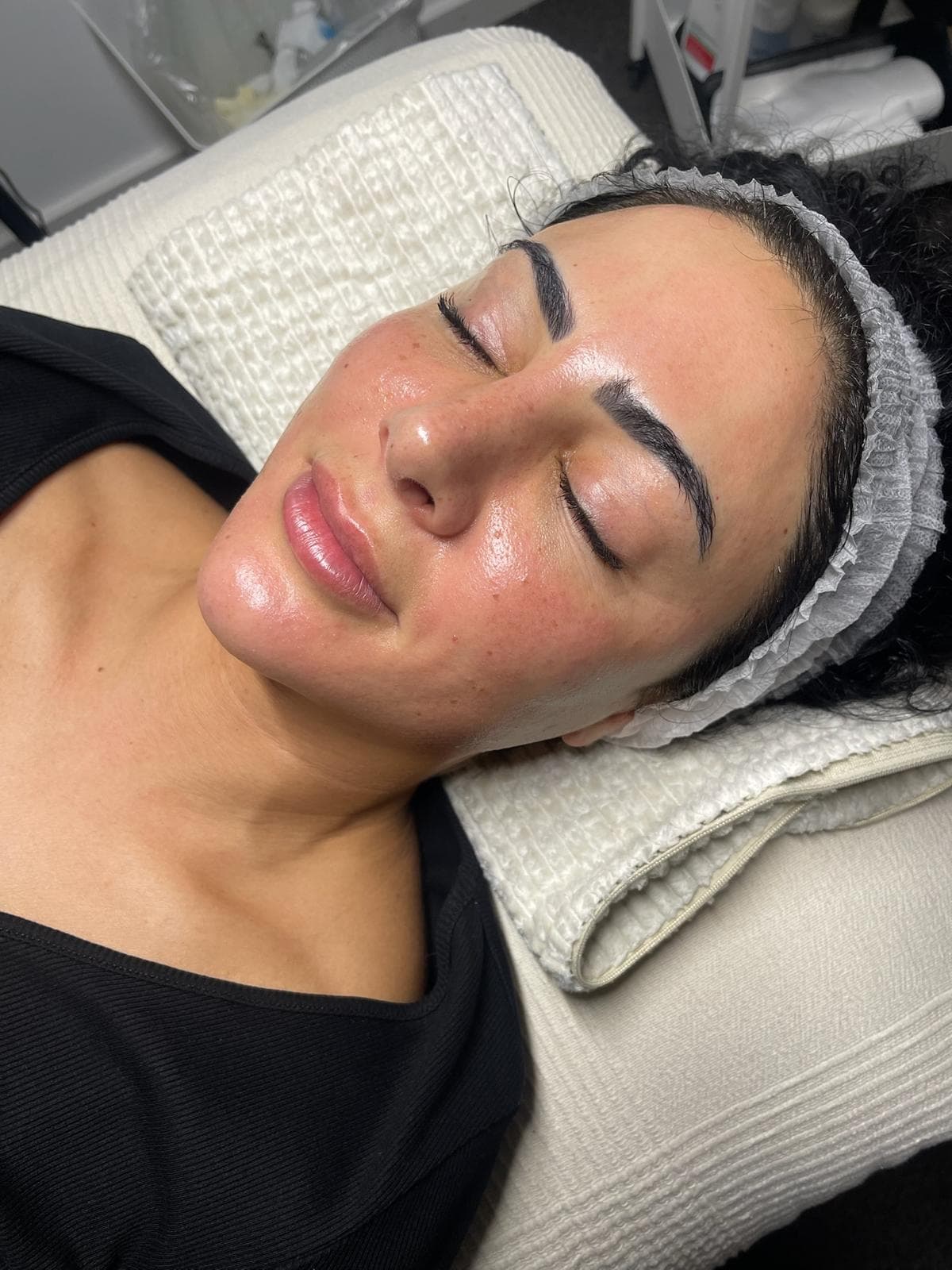 RF Microneedling 7