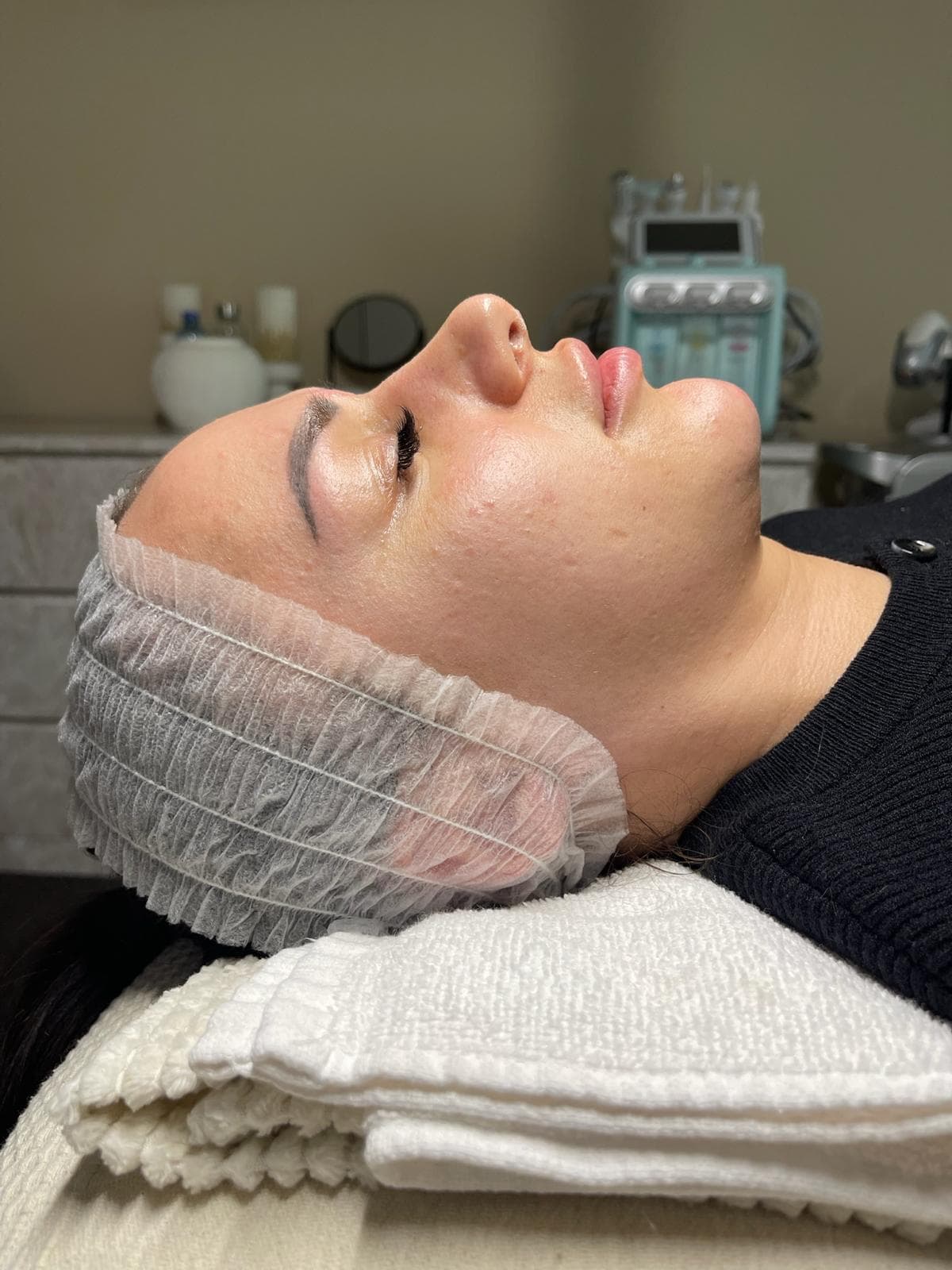 RF Microneedling 8