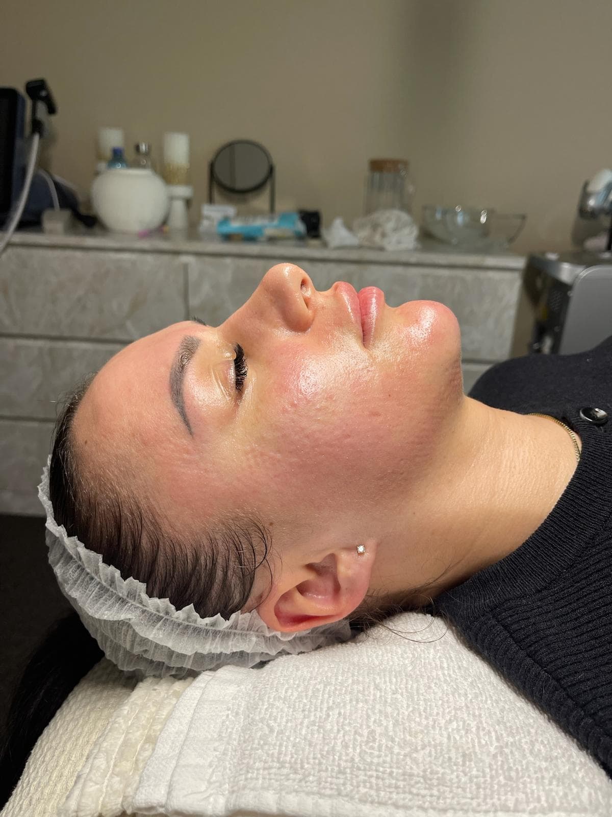 RF Microneedling 9