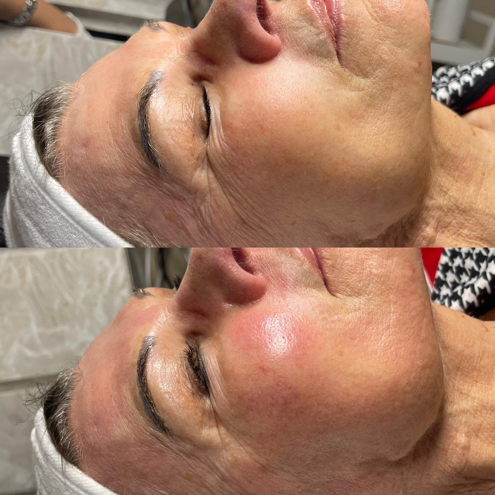 RF Microneedling 10