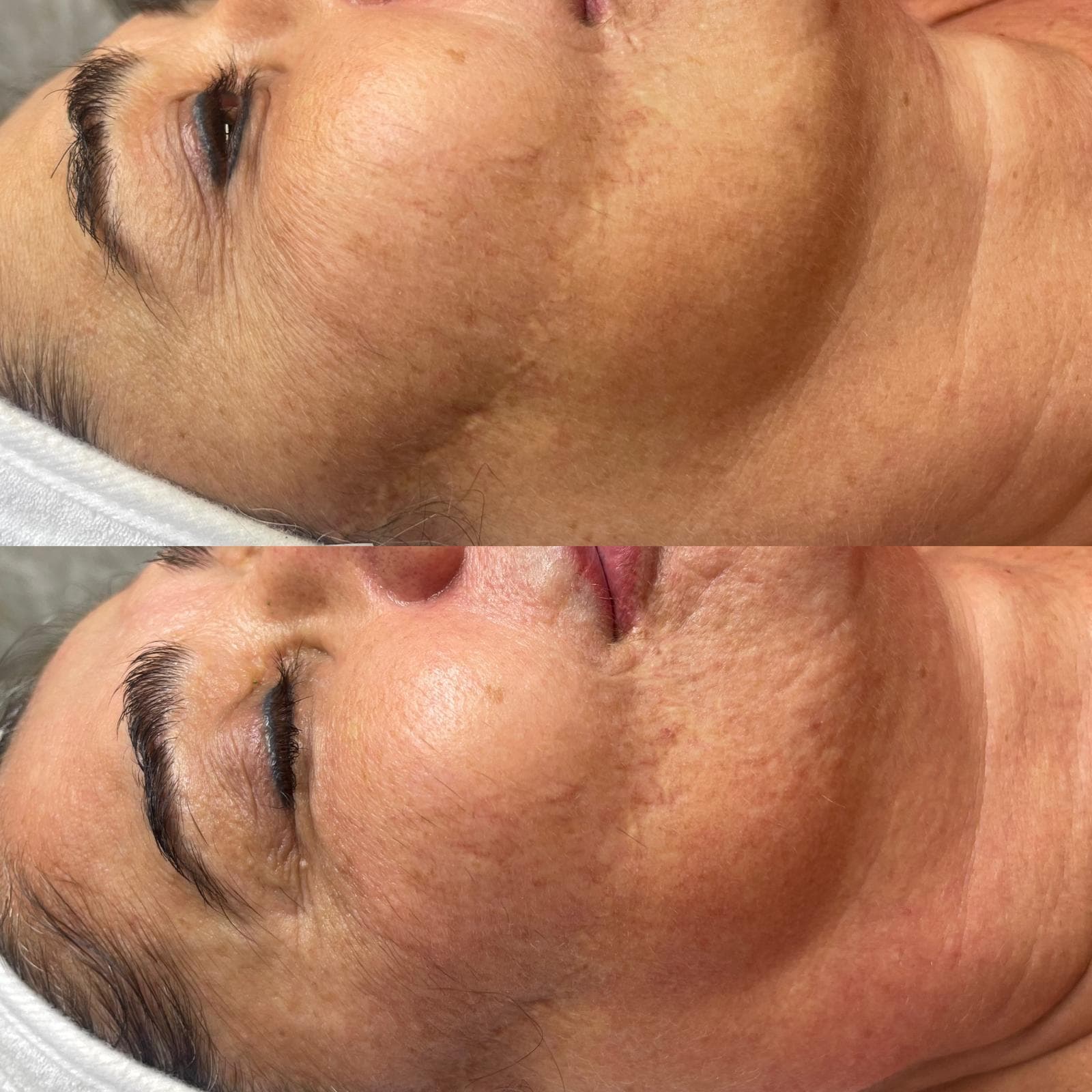 RF Microneedling 11