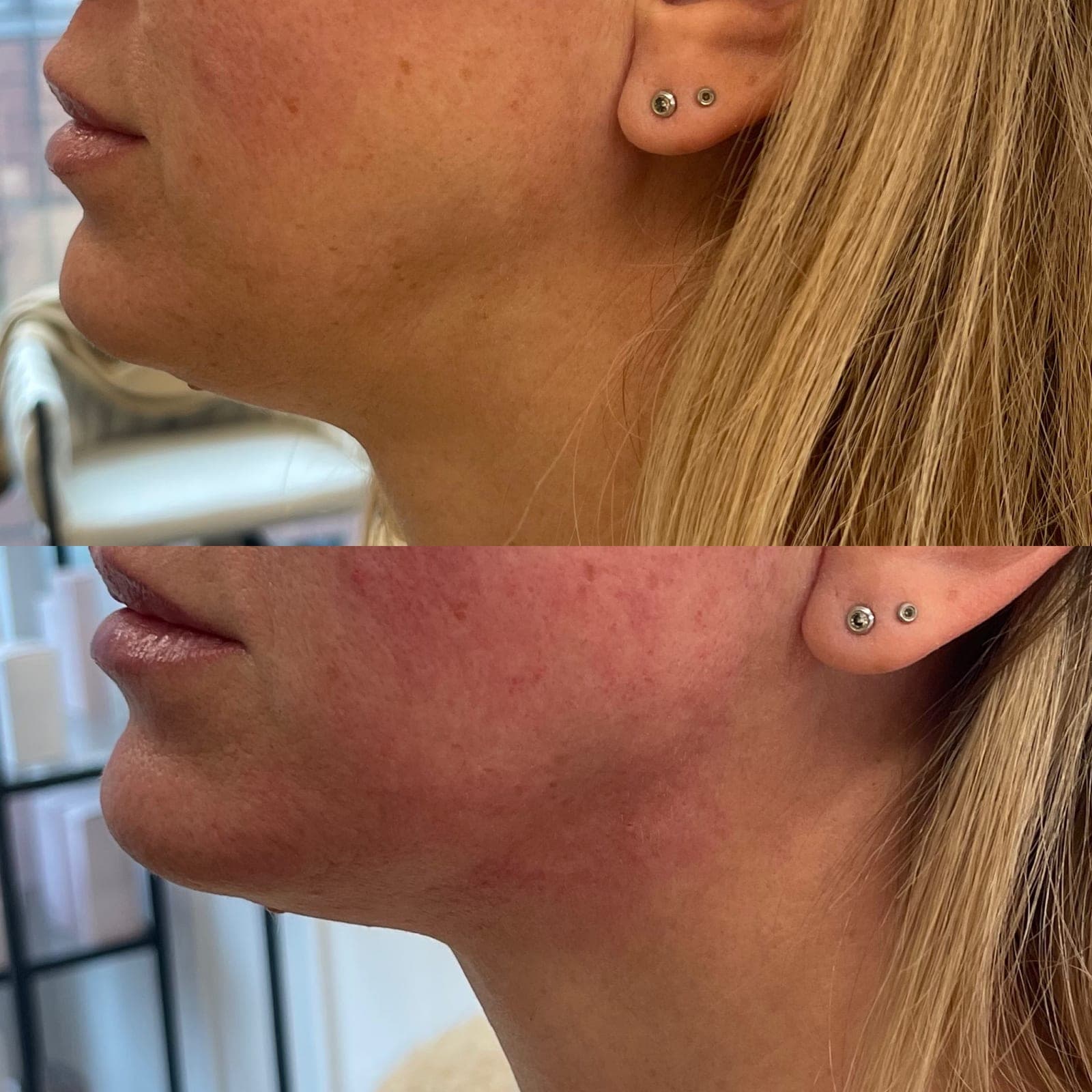 Gesichtskonturierung Vorher Nachher München – Body Shaper bei Nue Beauty