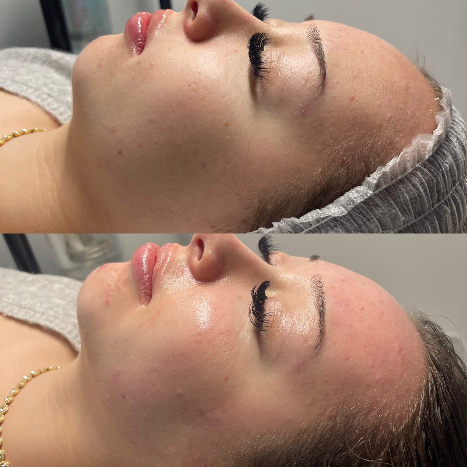 Microneedling BB Glow — Hautverjüngung — Vorher/Nachher