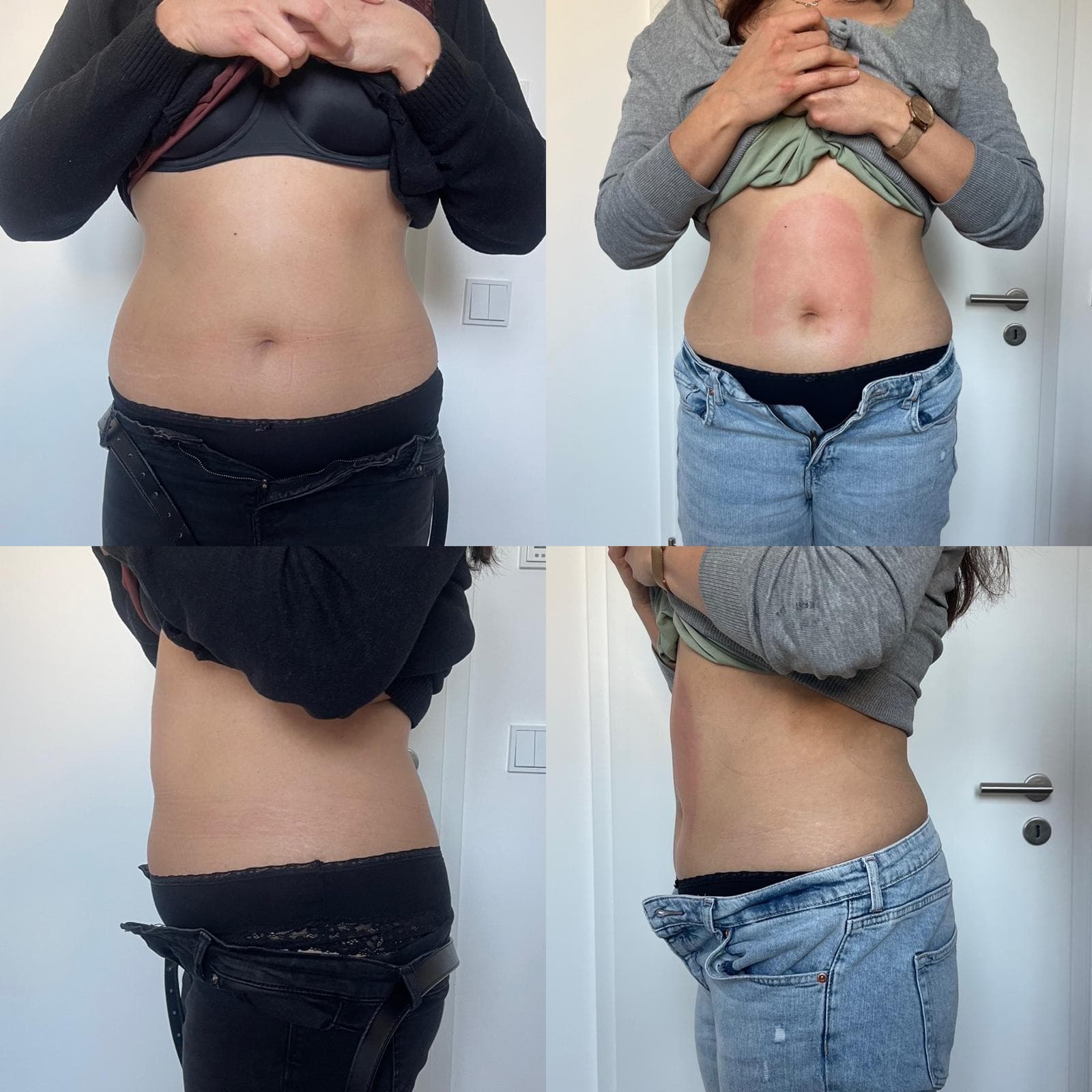 Body Shaper Ergebnis München – Körperformung mit Ultraschall und Radiofrequenz