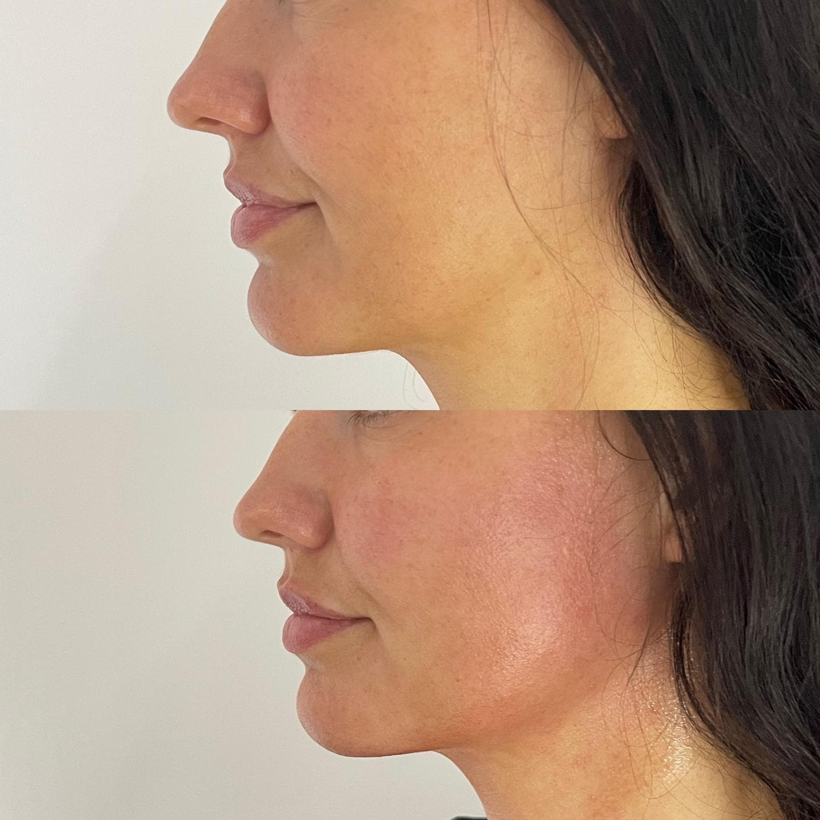 Jawline Konturierung München – definiertes Kinn nach Body Shaper