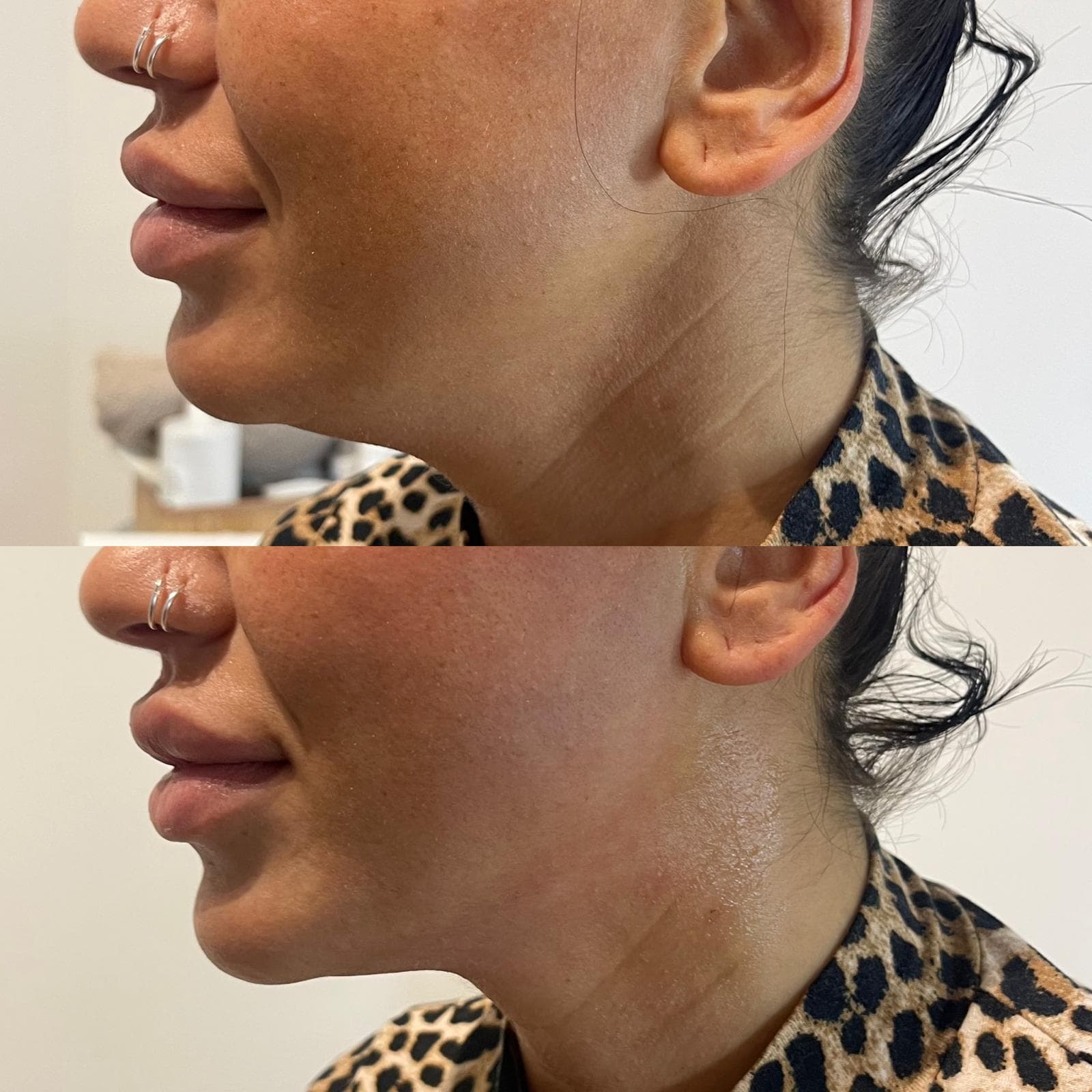 Body Shaper Jawline Vorher Nachher München – Kinnkonturierung bei Nue Beauty