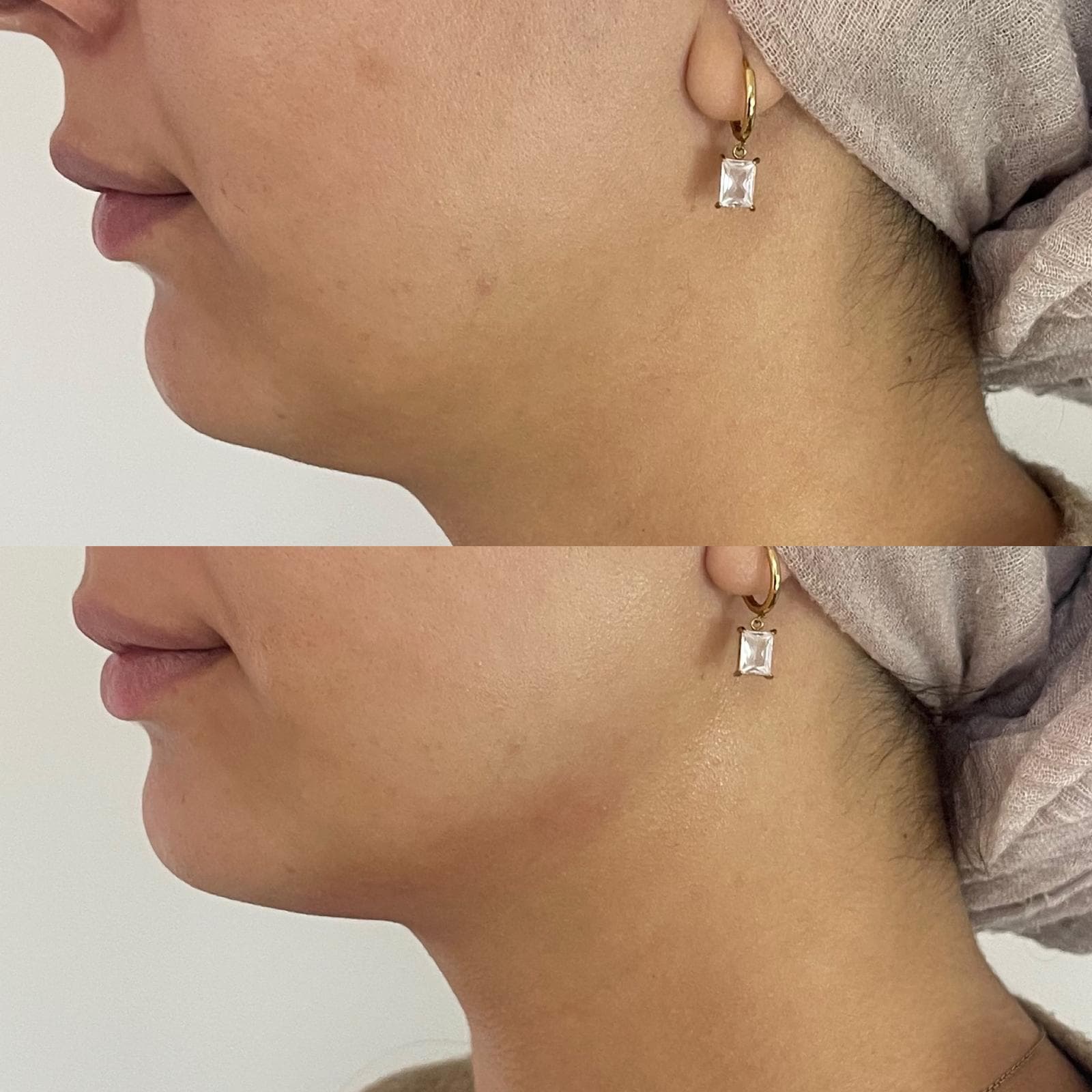 Jawline Body Shaper Vorher Nachher München – sichtbare Kinnkonturierung